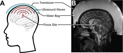 Focused Ultrasound for Noninvasive, Focal Pharmacologic Neurointervention